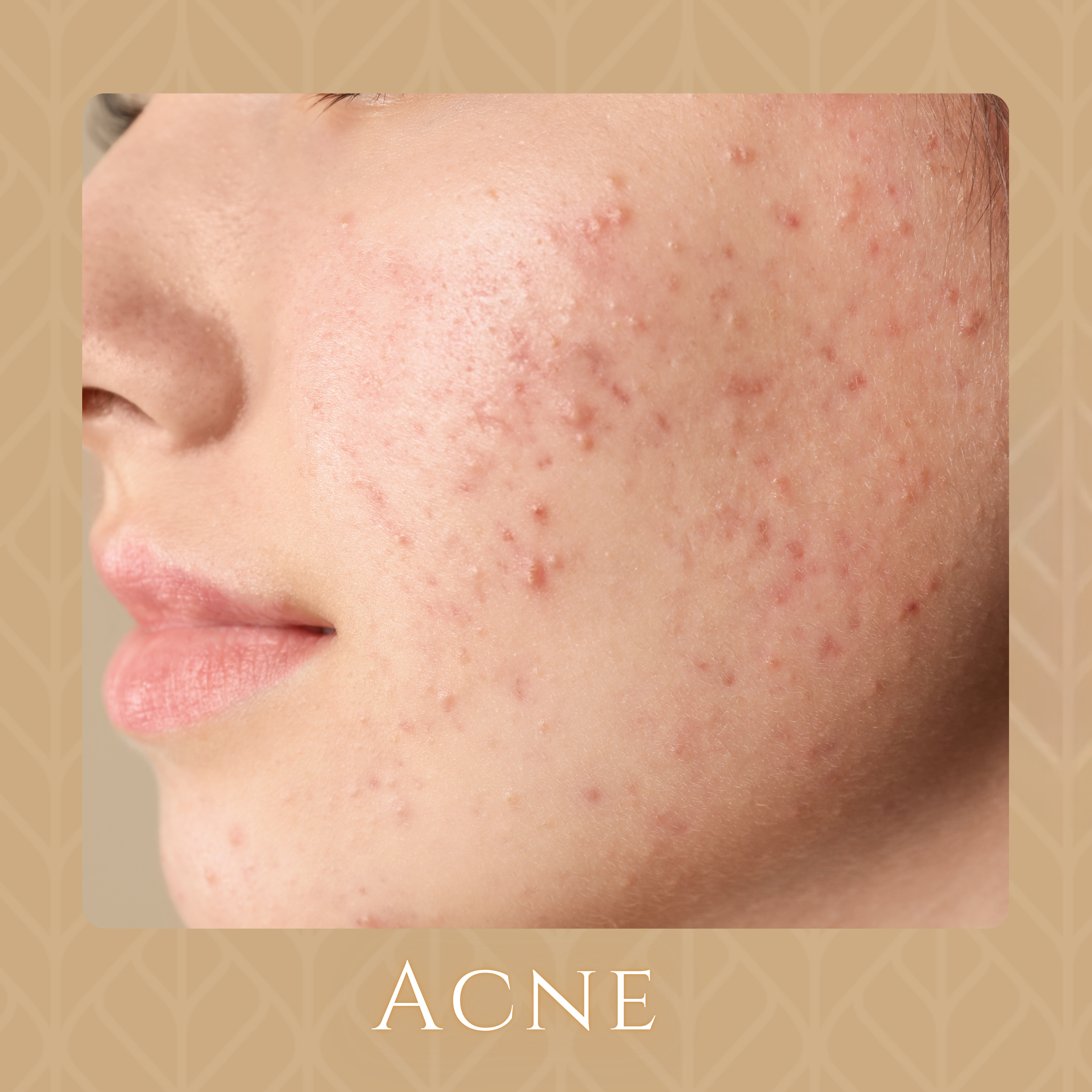 Acne