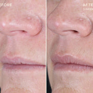 OURSELF REPLENISHING LIP FILLER with Tiered-Release Vesicle Delivery Technology™