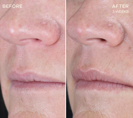 OURSELF REPLENISHING LIP FILLER with Tiered-Release Vesicle Delivery Technology™