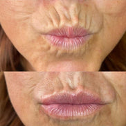 Corrective Lip Contour Wrinkle Filler