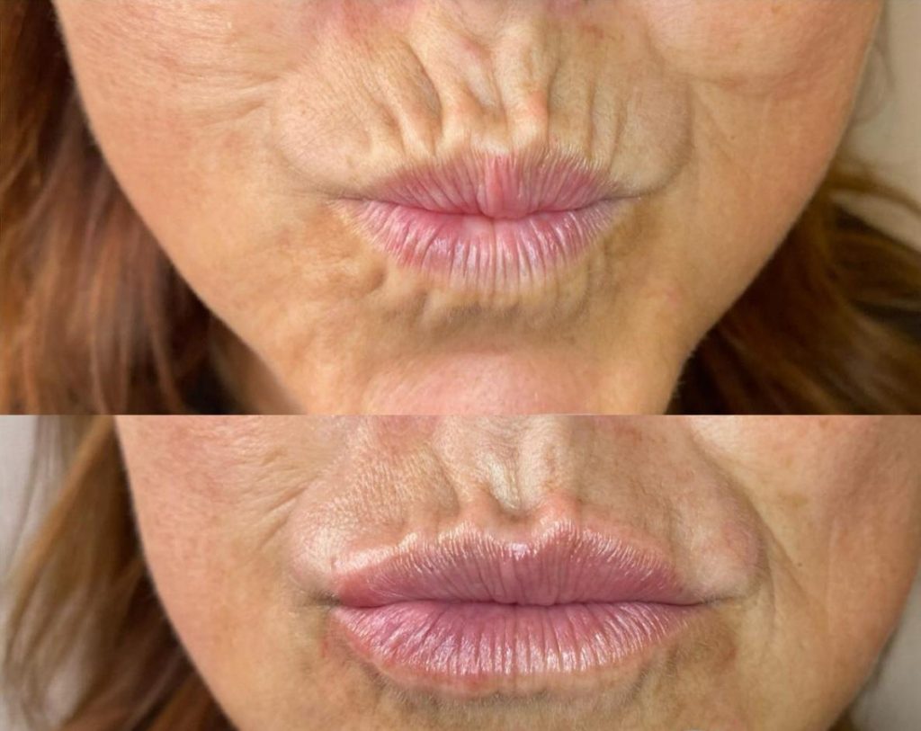 Corrective Lip Contour Wrinkle Filler