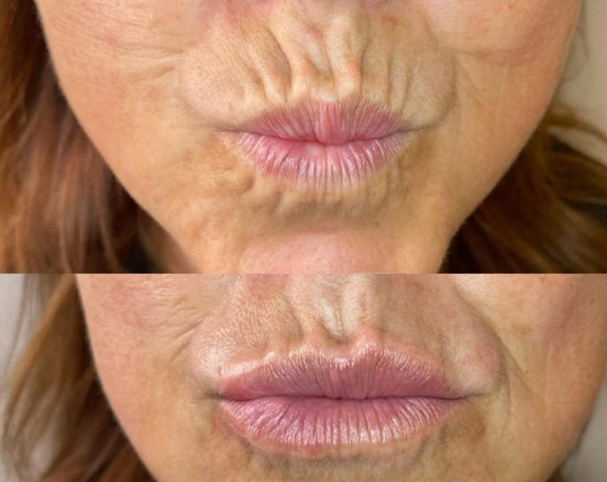 Corrective Lip Contour Wrinkle Filler